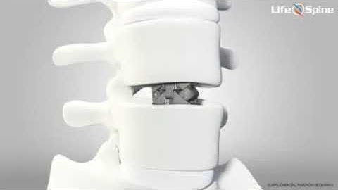 Life Spine: ProLift Expandable Spacer System
