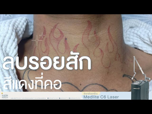 ลบรอยสัก EP.371/ปัญหาคาใจ...รอยสักสีแดงลบได้มั้ย? @หมอปุ๊ Neramit Clinic