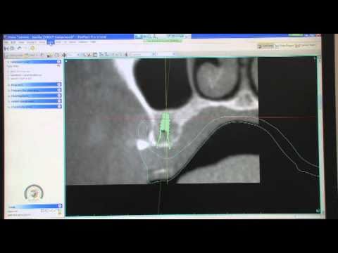 CT Planning For Implants: Don&#039;t Let The Panoramic Fool You Part 1