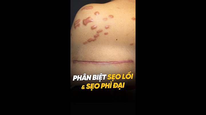 So sánh sẹo lồi và phì đại