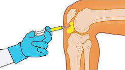 NYC Pain MD Stem Cell  Knee Arthritis Treatment