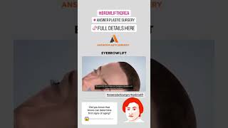 Eyebrow Lift | Answer Plastic Surgery #shorts #eyebrowlift