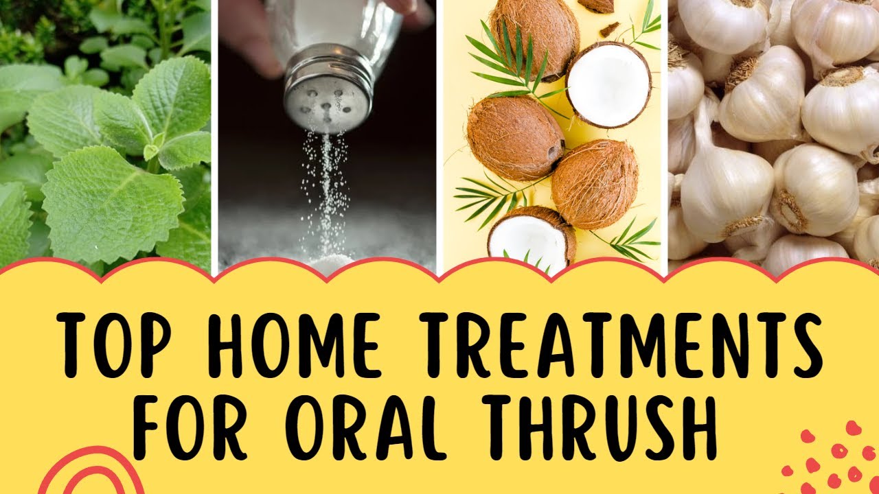 Top Home Treatments for Oral Thrush Yeast Infection aka Candida - YouTube