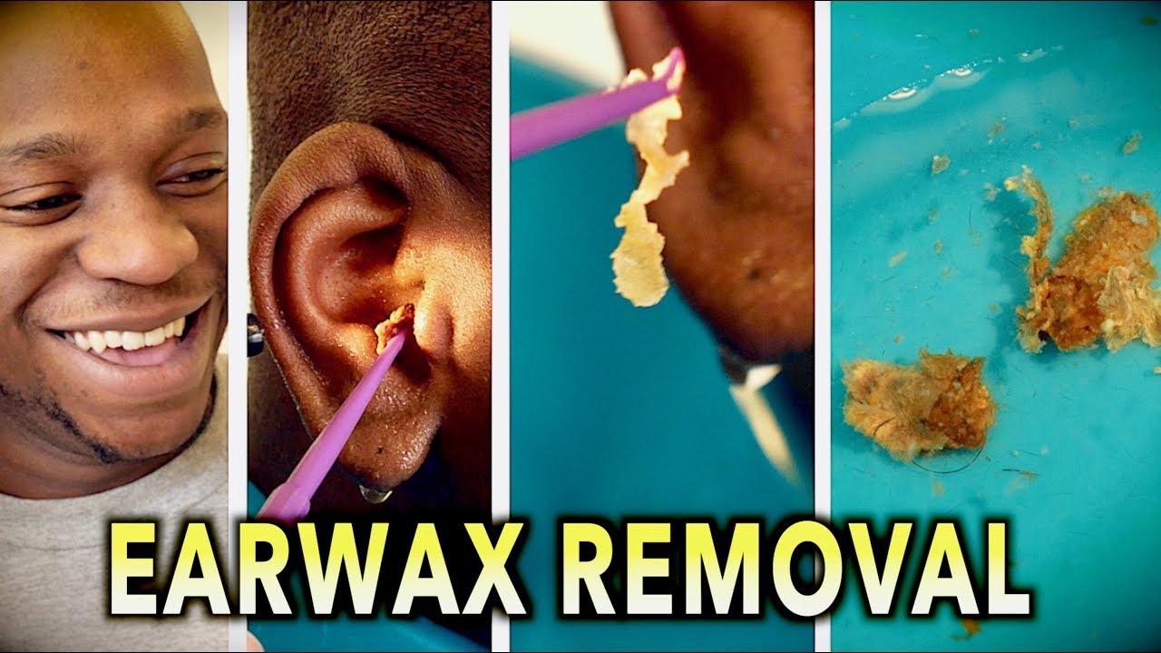 ENDLESS EARWAX REMOVAL! Dr. Paul (feat. Themba "my son") YouTube