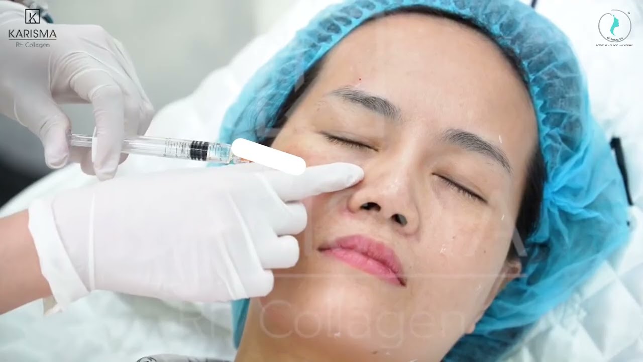 Kỹ thuật tiêm BAP K15+ Karisma Rh Collagen giảm nếp nhăn, trẻ hóa da