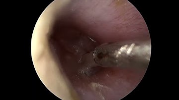 Ear tube placement (myringotomy)