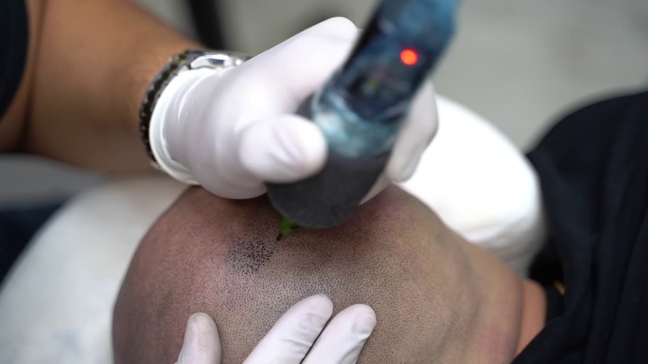 Time lapse video • Scalp Micropigmentation Full Session (Hair Tattoo)