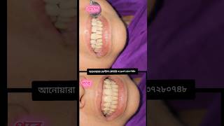 🦷 Smile Makeover with Composite Veneer ✨Broken, uneven, discolored or gap teeth?