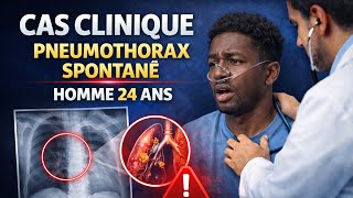 🫁 Pneumothorax spontané : reconnaître et agir | Cas clinique