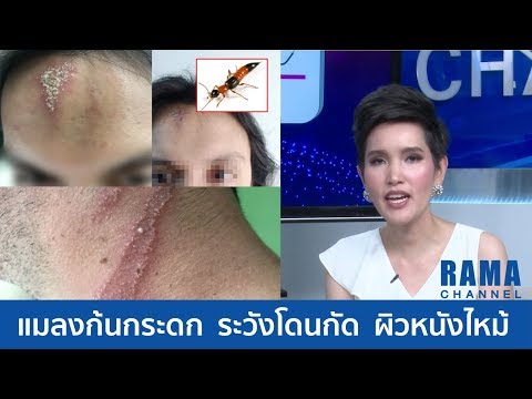 แมลงสาบ ระวังโดนกัด ผิวไหม้!  ข้อแนะนำในการปฐมพยาบาลและการรักษา : คลิปสั้นๆ พบ ดร.รามา