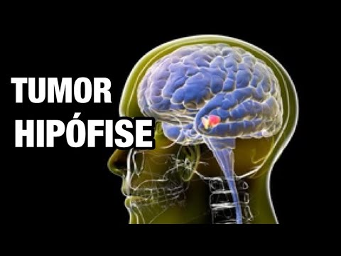 🚨 ALERTA! TUMORES DE HIPOFISE | O que são, sintomas e tratamento cirúrgico