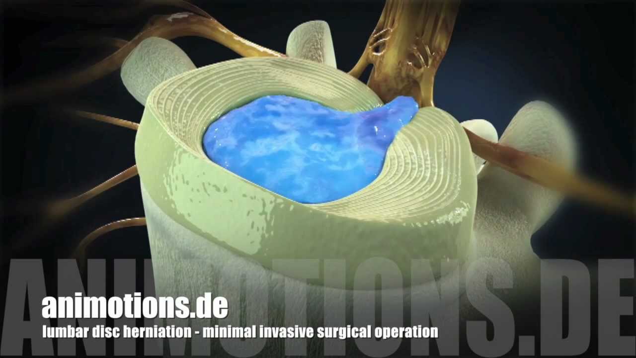 Herniation "lumbar", Treatment, Surgery (3D Animation) YouTube