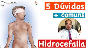 Quem tem hidrocefalia pode ter uma vida normal?