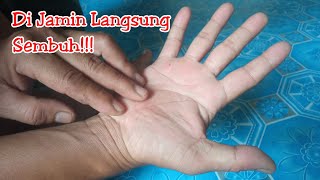 Ampuh Buanget!!!! Cara Mengatasi Telapak Tangan Yang Gatal