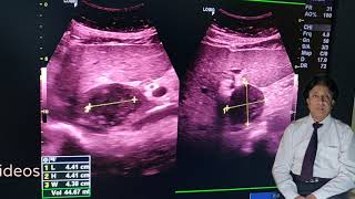Caudate Lobe Liver Abscess Rarely Seen. Causes? Tips To See On Ultrasound, Treatment ,