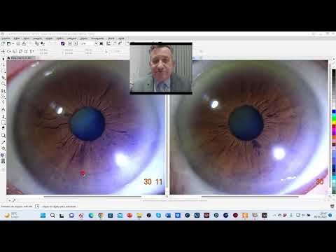 CASOS DE IRIDOLOGIA EM 5 MINUTOS 2