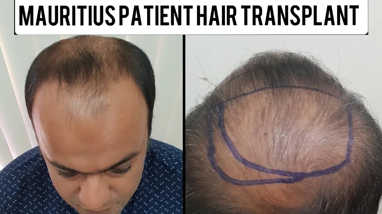 Best Hair transplant Mumbai Hair transplant Review Mauritius Patient