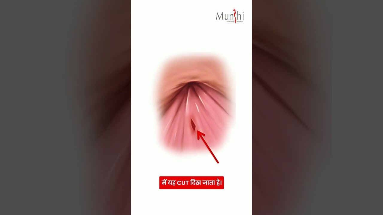 PPL Series Episode 3: Let's understand Anal Fissures today! 