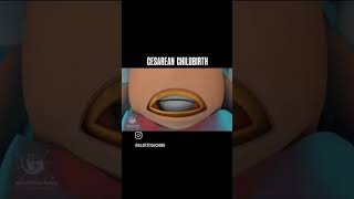 cesarean childbirth #momlife #mom #delivery #chidbirth #newborn #shorts