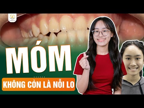 Niềng Răng Móm – Bí Quyết Thay Đổi Ngoại Hình Ngoạn Mục — Bác sĩ Trung Long Biên