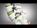 Spondylolisthesis