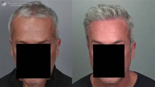 Hair Transplant Before and After- 3694 Grafts, FUT, PRP, FDA,Reced