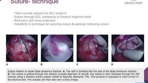 Paediatric Tibial Eminence Fractures by Dr Amy Gib...