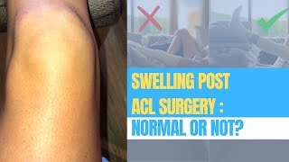 Why Is My Knee Still Swollen After ACL Surgery?
