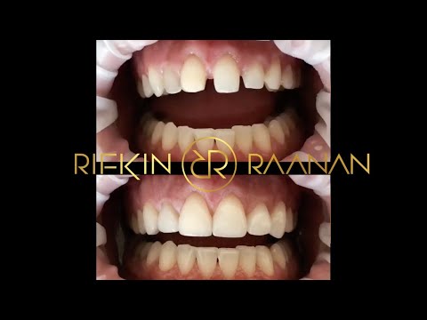 placement-of-porcelain-veneers-by-dr-rodney-raanan-md,-mmsc-beverly-hills-cosmetic-dentist
