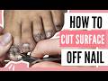 How to Fix Nail Fungus Toenails at Home No Medication
