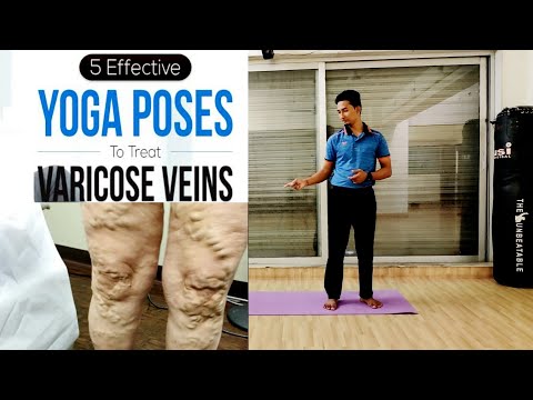 5 Effective Yoga Poses to Treat Varicose Vein | Yoga for Varicose Veins | Varicose Veins Treatment