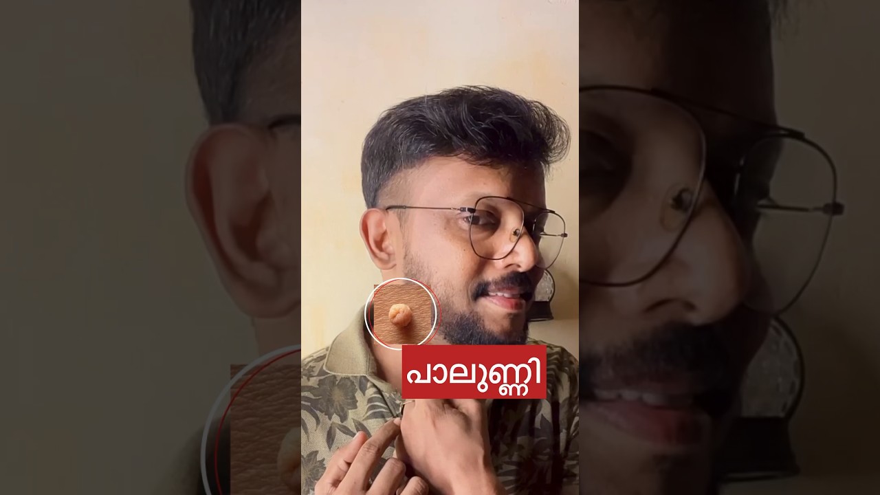 പാലുണ്ണി,മുഖകുരു പോകാൻ ഇരട്ടിമധുരം ഇങ്ങനെ തേച്ചാൽ മതി 👌❤️✌️
