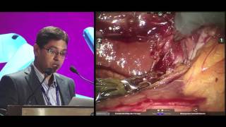 Robotic ALPPS Stage 1 and Simultaneous Robotic Low Anterior Resection- Dr Basant Mahadevappa