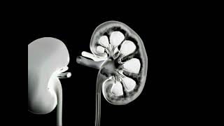 Böbrek Taşı Ameliyatı Nasıl Yapılır? Perkütan Nefrolitotomi Pnl Basit Anlatım