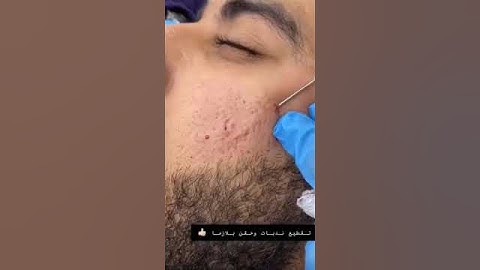 (Subcision) تقنية تقطيع الالياف لعلاج ندبات حب الشباب وعلاج حفر الوجه