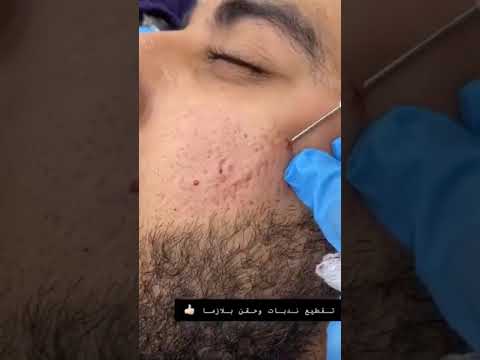 فيديو: 4 طرق للتخلص من الندوب من ثقوب البطن