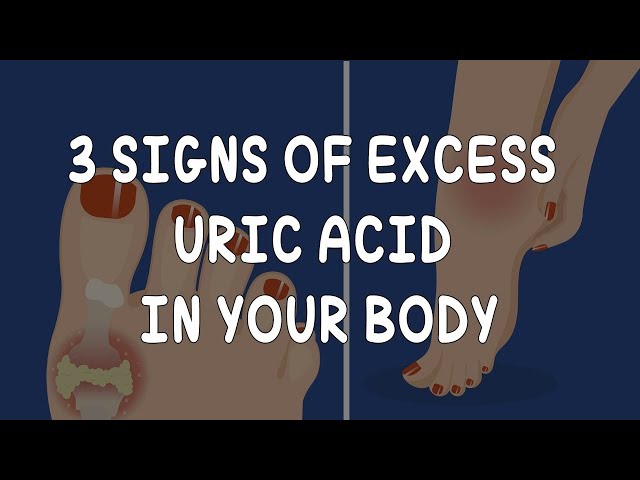 [GOUT] - 3 Signs of Excess Uric Acid in Your Body - AzchanneL class=