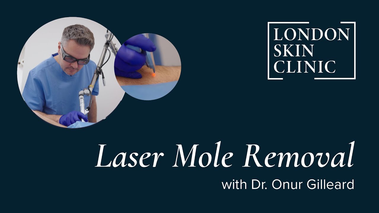 Experience Laser Mole Removal | A Quick and Easy Procedure | London Skin Clinic