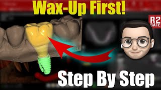 [Eng] Virtual Wax-up Placement
