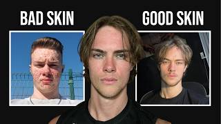 The Only Reason Why you Have Acne ( Free Course Module )