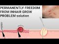 hair ingrow problem hair ingrow removal satisfying