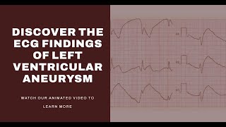 Ecg Insights: Identifying Left Ventricular Aneurysm - A Diagnostic Approach