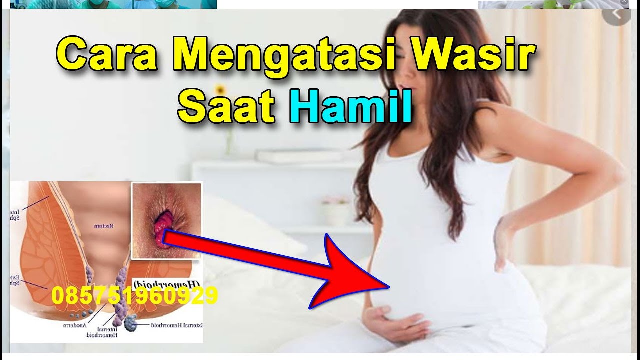 Cara Mengatasi Wasir Saat Hamil