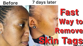 How To Remove Skin Tags Warts That Worksclear Skin Tags Now 100%