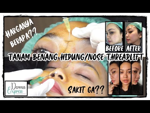 TANAM BENANG HIDUNG / NOSE THREADLIFT || DERMA EXPRESS JAKARTA - UTAN KAYU