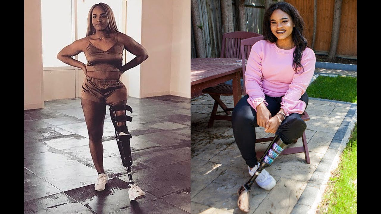 Empowered Teen Proud of Prosthetic Leg | SHAKE MY BEAUTY