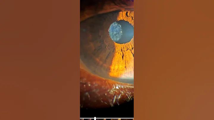 YAG Laser capsulotomy for secondary cataracts || #ophthalmology #ophthalmic #optometry