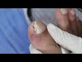 Ep_2455 Toenail removal 👣 เล็บจม และ ปักเข้าที่เนื้อ 😷 (This clip is from Thailand)