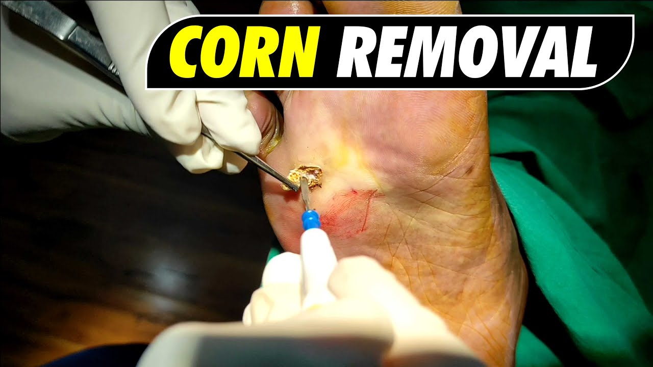 Foot Corn Removal | Corn Removal - YouTube