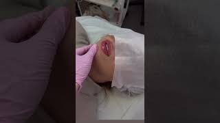 Контурная пластика губ 👄